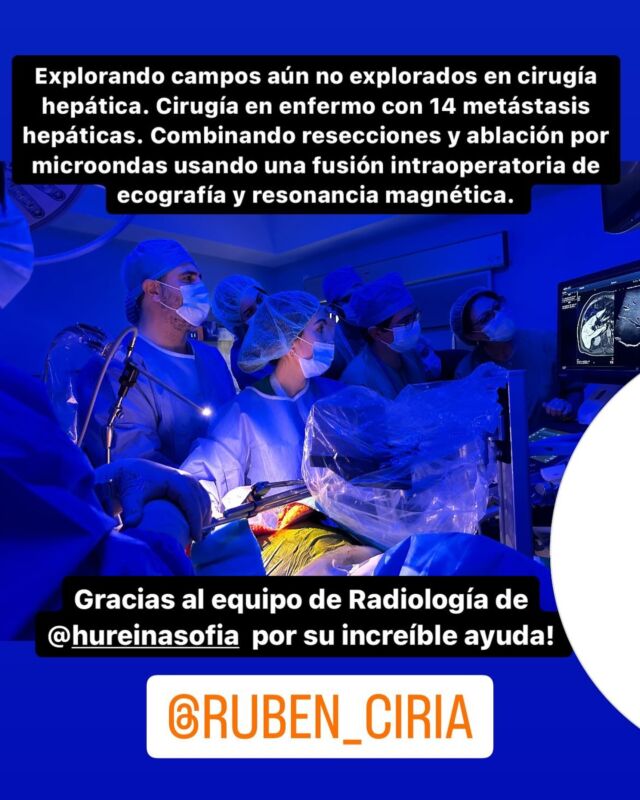 Explorando campos aún no explorados en cirugía hepática. Cirugía en enfermo con 14 metástasis hepáticas. Combinando resecciones y ablación por microondas usando una fusión intraoperatoria de ecografía y resonancia magnética. Algo nunca hecho en cirugía hepática. Moving forward! 
@cordobabn @diario_cordoba @hureinasofia @quironsalud @aecirujanos @contraelcancer.cordoba #cirugia #salud #medicina #surgery #cirujano #laparoscopia #cancer #metastasis
